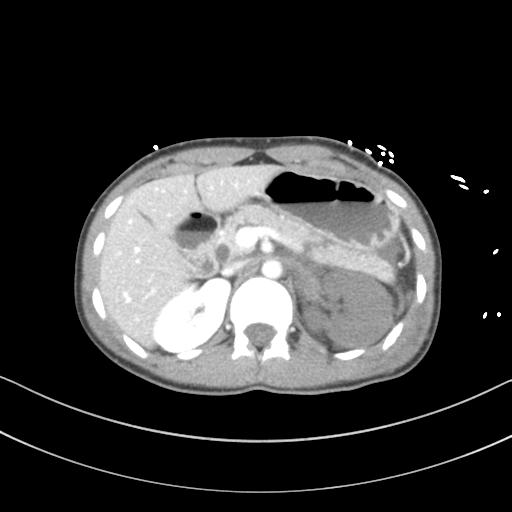 Abdominal multi-trauma - devascularised kidney and liver, spleen and pancreatic lacerations (Radiopaedia 34984-36486 Axial C+ portal venous phase 26).png