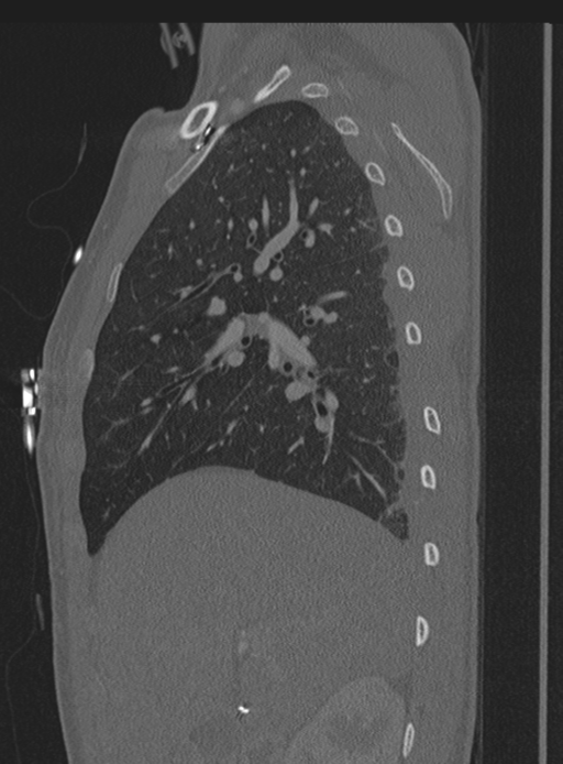 Abdominal multi-trauma - devascularised kidney and liver, spleen and pancreatic lacerations (Radiopaedia 34984-36486 Sagittal bone window 67).png