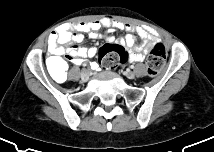 Abdominal wall and retroperitoneal tuberculosis (Radiopaedia 88137-104729 Axial C+ portal venous phase 134).jpg