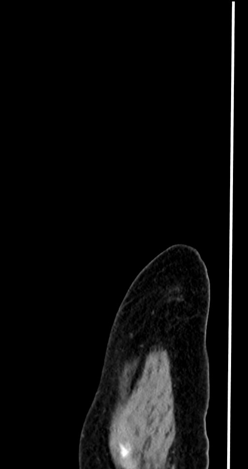Abdominal wall and retroperitoneal tuberculosis (Radiopaedia 88137-104729 Sagittal C+ portal venous phase 8).jpg