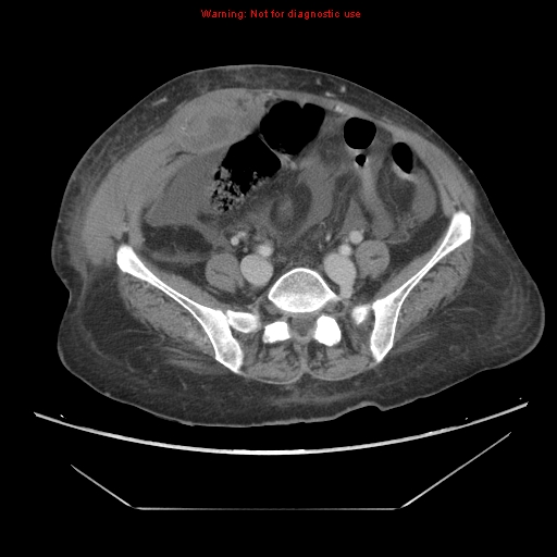 File:Abdominal wall hematoma (Radiopaedia 9427-10112 Axial C+ portal venous phase 75).jpg