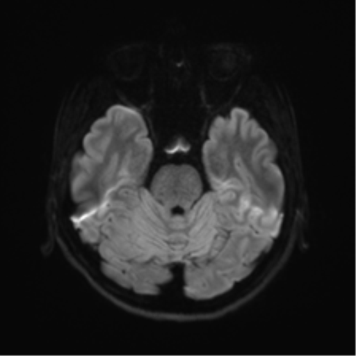 Abducens nerve palsy (Radiopaedia 51069-56648 Axial DWI 35).png