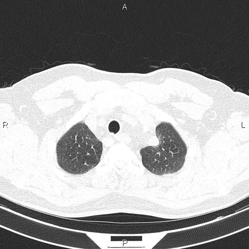 Aberrant right subclavian artery (Radiopaedia 87093-103354 Axial lung window 18).jpg