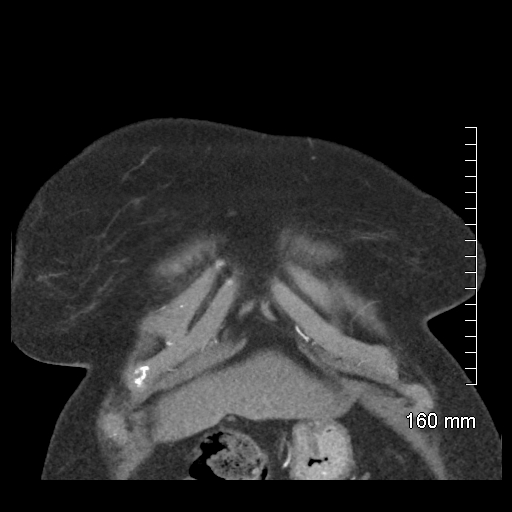 Aberrant right subclavian artery stenosis (Radiopaedia 52656-58670 B 15).jpg