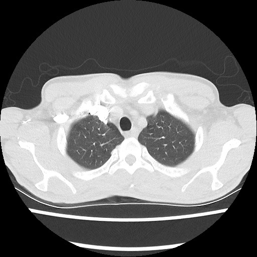 Accessory left horizontal fissure with lingular pneumonia (Radiopaedia 53763-59843 Axial lung window 11).jpg