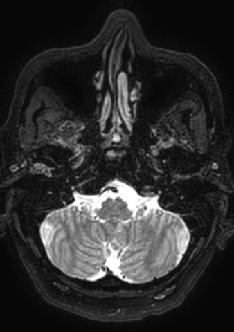 Accessory middle cerebral artery (Radiopaedia 73114-83828 Axial T2 188).jpg