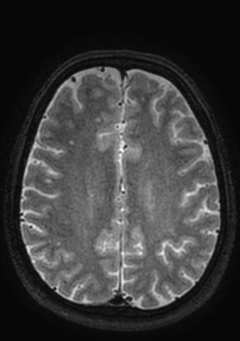 File:Accessory middle cerebral artery (Radiopaedia 73114-83828 Axial T2 5).jpg