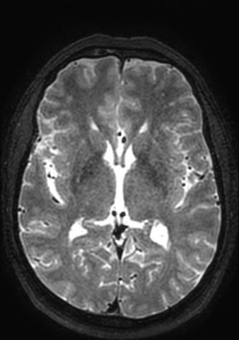 File:Accessory middle cerebral artery (Radiopaedia 73114-83828 Axial T2 68).jpg