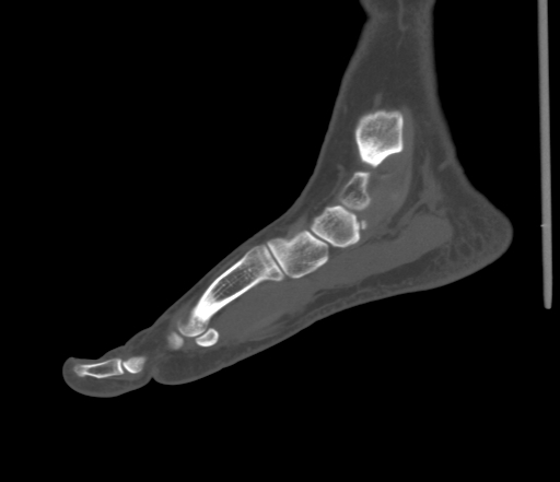 File:Accessory navicular bone (Radiopaedia 54999-61314 Sagittal non-contrast 36).jpg