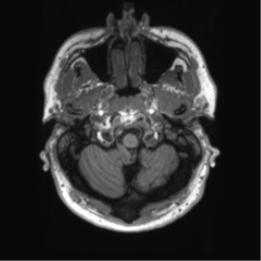 File:Achondroplasia (Radiopaedia 65109-74105 Axial T1 49).png