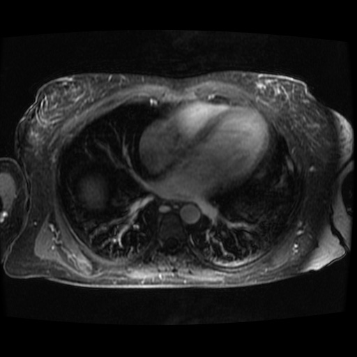 Acinar cell carcinoma of the pancreas (Radiopaedia 75442-86668 D 147).jpg
