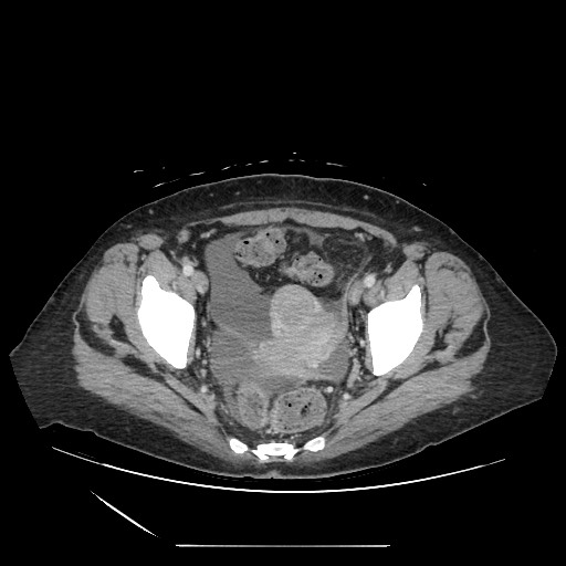 File:Acinar cell carcinoma of the pancreas (Radiopaedia 75442-86669 Axial C+ portal venous phase 130).jpg