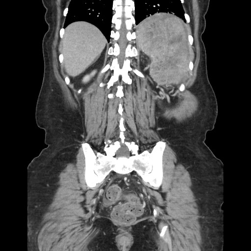 File:Acinar cell carcinoma of the pancreas (Radiopaedia 75442-86669 Coronal C+ portal venous phase 99).jpg