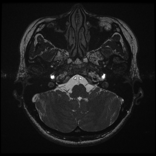 Acoustic neuroma (Radiopaedia 34049-35283 Axial 33).png