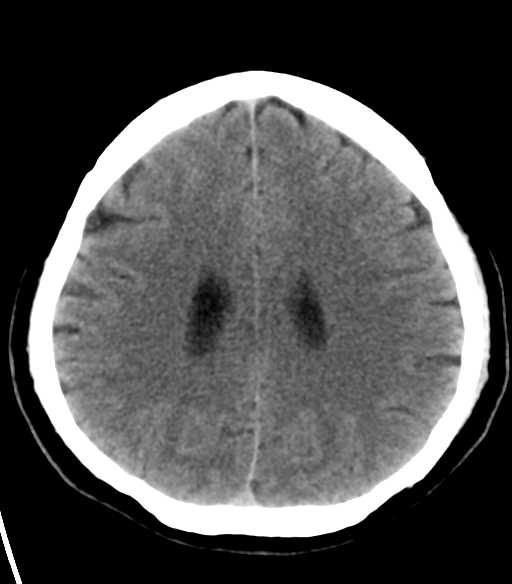 File:Acoustic schwannoma (Radiopaedia 33045-34065 Axial non-contrast 19).png