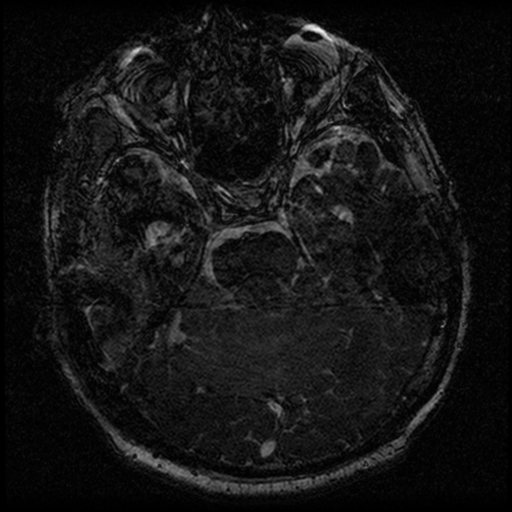 File:Acoustic schwannoma (Radiopaedia 39170-41387 Axial FIESTA 100).png