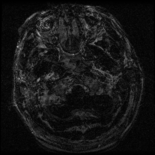 File:Acoustic schwannoma (Radiopaedia 39170-41387 Axial FIESTA 3).png
