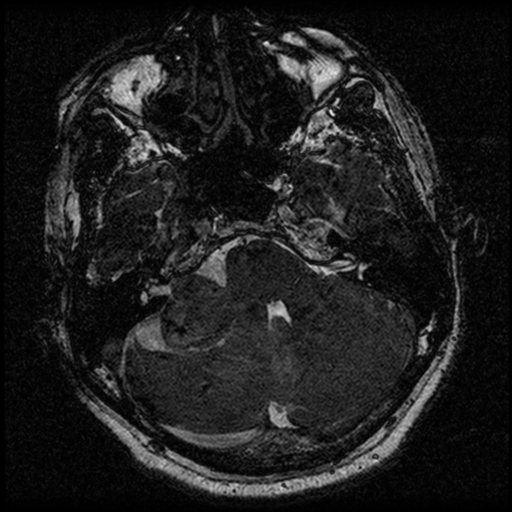 File:Acoustic schwannoma (Radiopaedia 39170-41387 Axial FIESTA 67).png