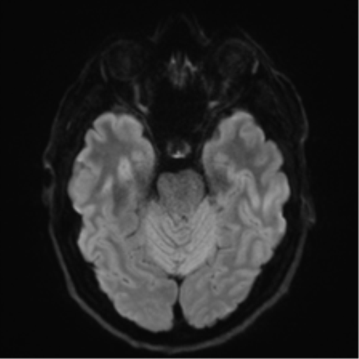 Acoustic schwannoma (Radiopaedia 50846-56358 Axial DWI 37).png