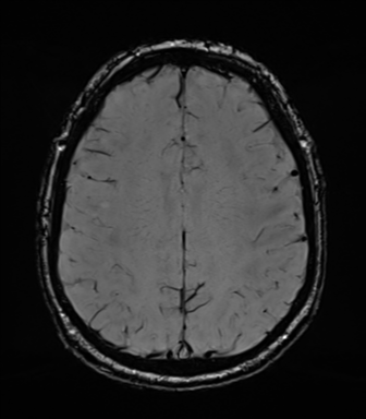 Acoustic schwannoma (Radiopaedia 50846-56358 Axial SWI 67).png