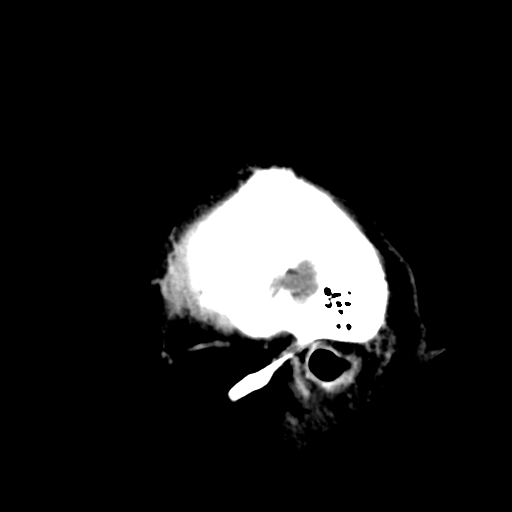 File:Acoustic schwannoma (Radiopaedia 55729-62280 Sagittal non-contrast 3).png