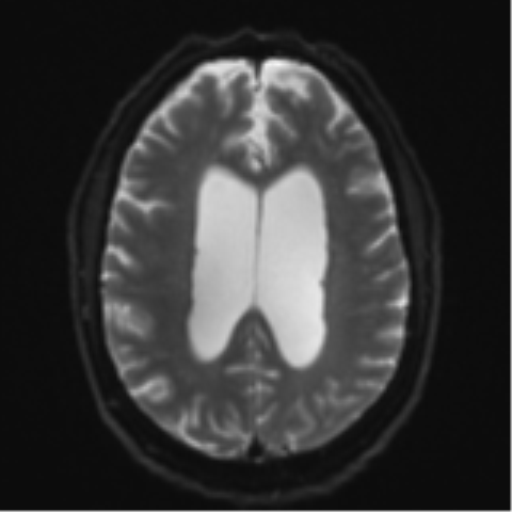 Acoustic schwannoma (Radiopaedia 55729-62281 E 18).png