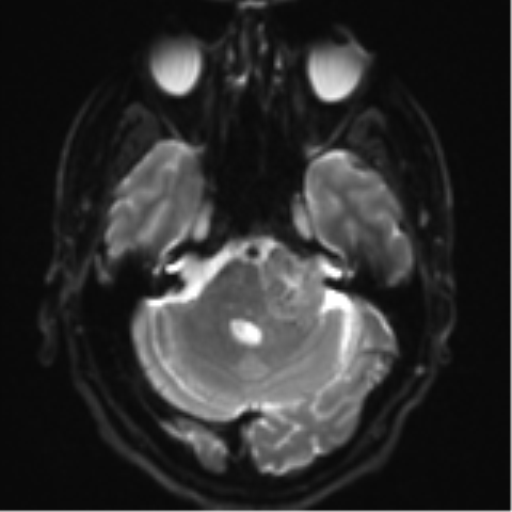Acoustic schwannoma (Radiopaedia 55729-62281 E 6).png