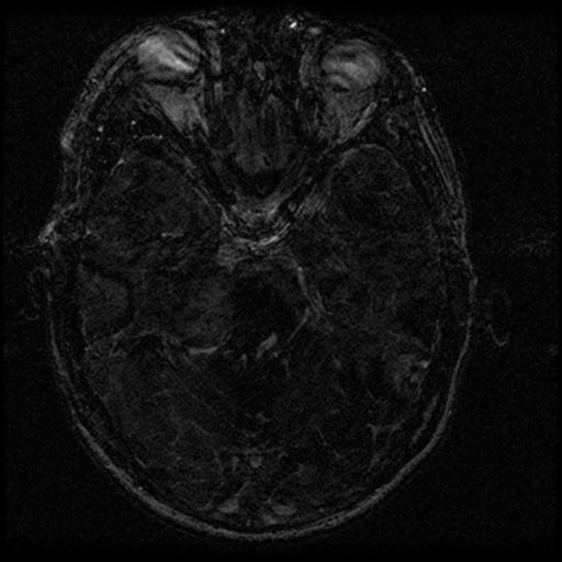 Acoustic schwannoma - eroding petrous apex (Radiopaedia 39674-42004 Axial T2 72).png