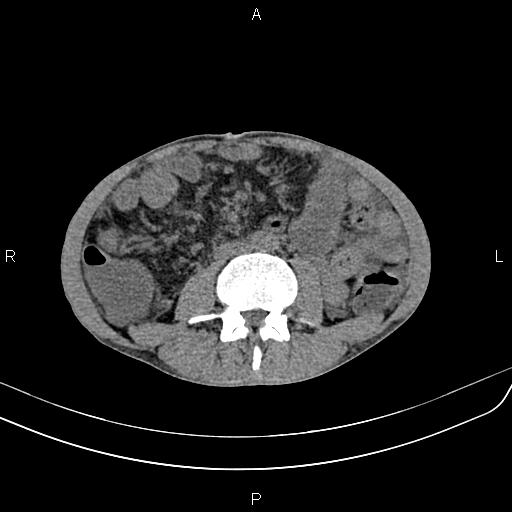 Active crohn disease (Radiopaedia 87133-103397 Axial non-contrast 56).jpg