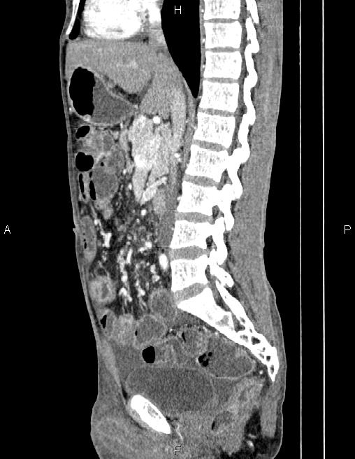 Active crohn disease (Radiopaedia 87133-103397 Sagittal C+ arterial phase 42).jpg