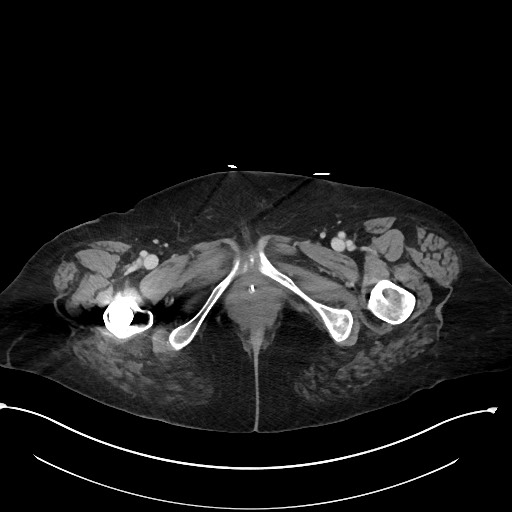 File:Active renal extravasation with large subcapsular and retroperitoneal hemorrhage (Radiopaedia 60975-68796 Axial 352).jpg