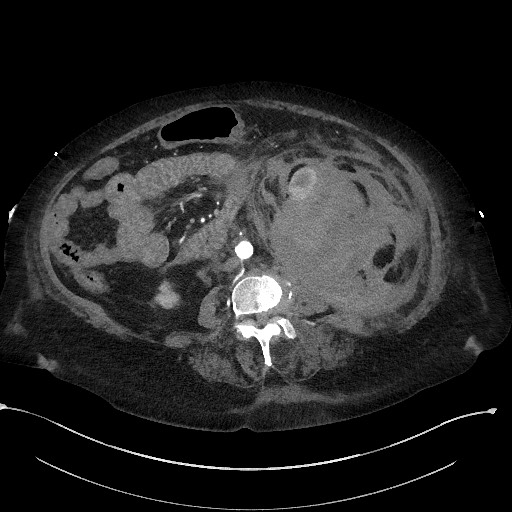 Active renal extravasation with large subcapsular and retroperitoneal hemorrhage (Radiopaedia 60975-68796 Axial C+ arterial phase 100).jpg