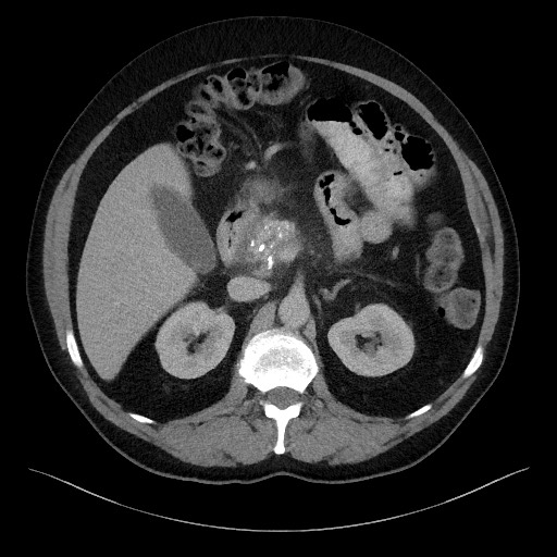 Acute-on-chronic pancreatitis (Radiopaedia 67286-76656 Axial C+ portal venous phase 28).jpg
