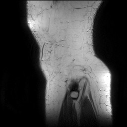 Acute-on-chronic transient lateral patellar dislocation with trochlear dysplasia (Radiopaedia 84099-99349 Sagittal PD 156).jpg