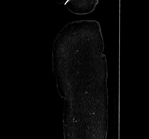 File:Acute appendicitis, heterotaxy syndrome (Radiopaedia 66884-76202 Sagittal C+ portal venous phase 11).jpg