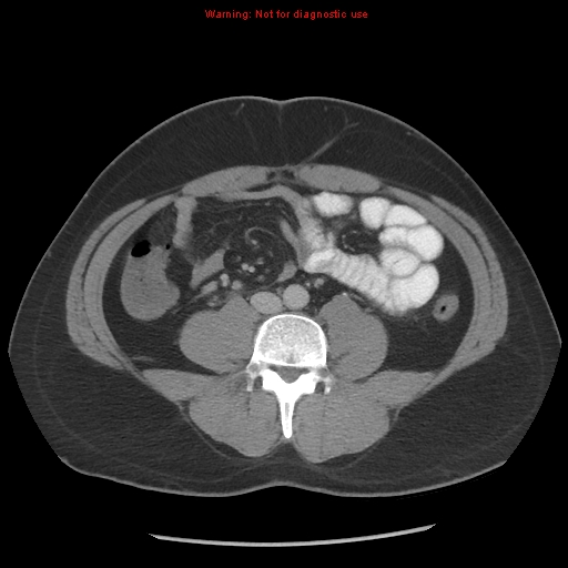 Acute appendicitis (Radiopaedia 10498-10973 Axial C+ portal venous phase 6).jpg