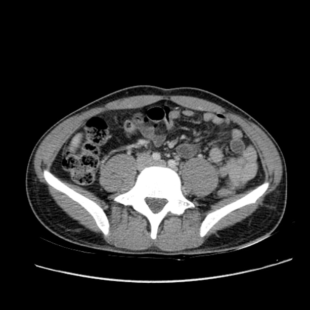 Acute appendicitis (Radiopaedia 27049-27227 Axial C+ portal venous phase 46).jpg