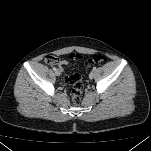 Acute appendicitis (Radiopaedia 38255-40270 Axial C+ portal venous phase 92).jpg
