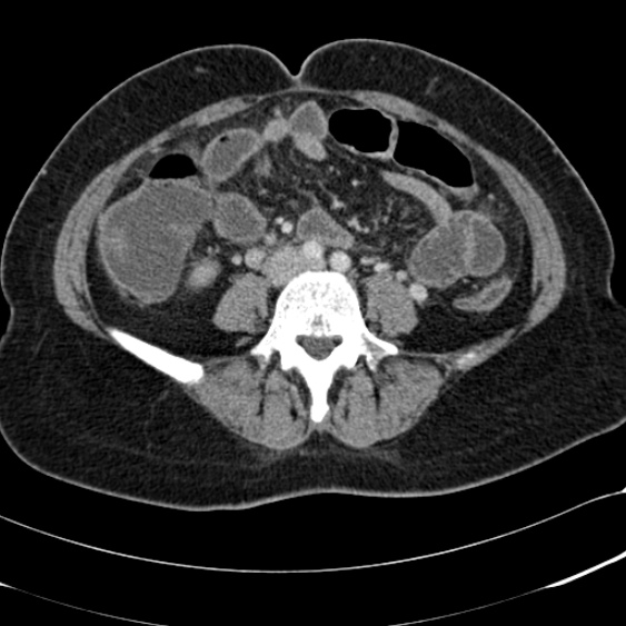 Acute appendicitis (Radiopaedia 48792-53822 Axial C+ portal venous phase 69).jpg