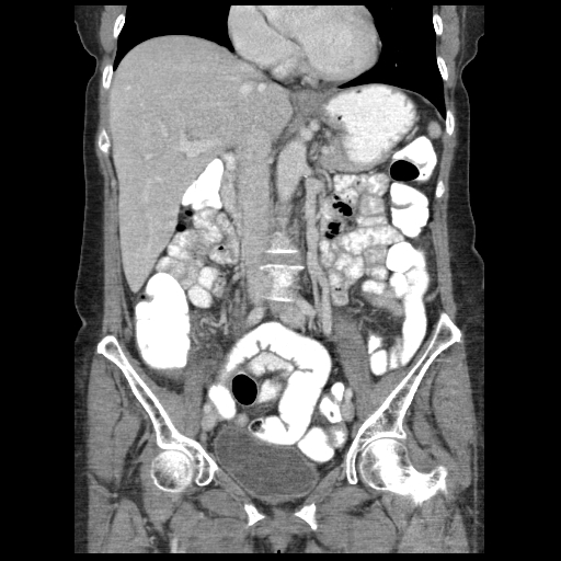 Acute appendicitis (Radiopaedia 52672-58589 Coronal C+ portal venous phase 49).jpg