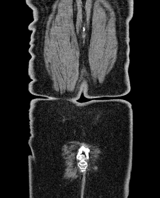 Acute appendicitis (Radiopaedia 58627-65818 Coronal non-contrast 62).jpg