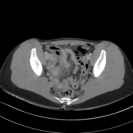 Acute appendicitis (Radiopaedia 62608-70901 Axial C+ portal venous phase 38).jpg