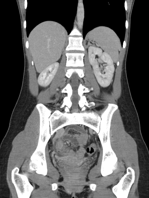 Acute appendicitis (Radiopaedia 62608-70901 Coronal C+ portal venous phase 36).jpg