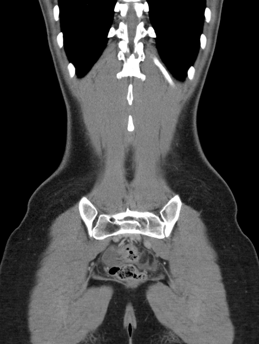 Acute appendicitis (Radiopaedia 62608-70901 Coronal C+ portal venous phase 54).jpg