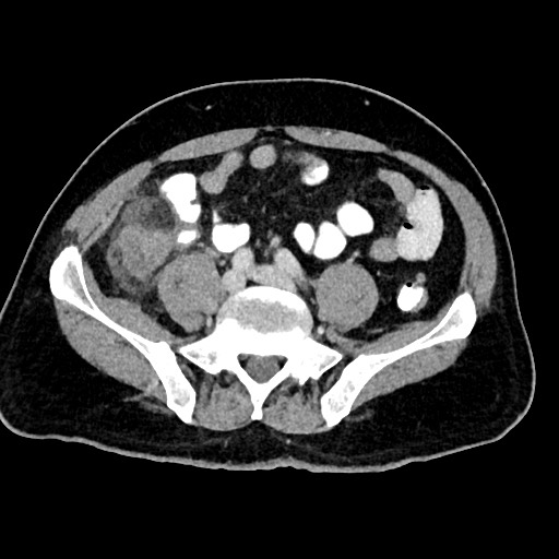 Acute appendicitis (Radiopaedia 77016-88960 Axial C+ portal venous phase 98).jpg
