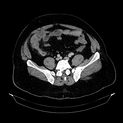 Acute appendicitis (Radiopaedia 79950-93224 Axial C+ portal venous phase 74).jpg