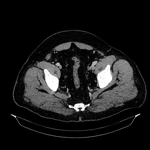 Acute appendicitis (Radiopaedia 79950-93224 Axial C+ portal venous phase 90).jpg