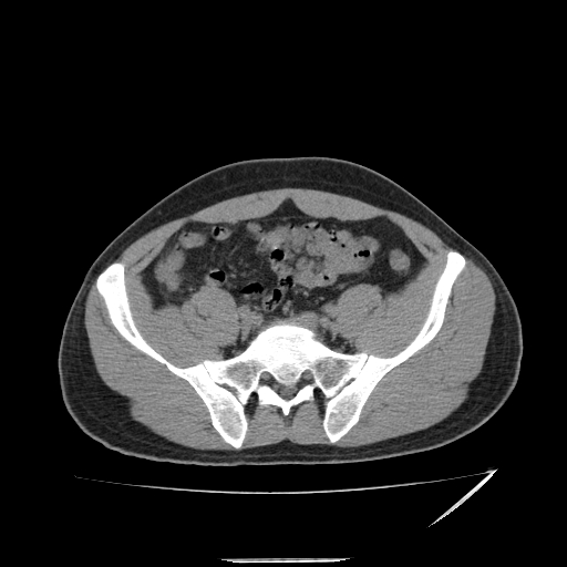 File:Acute appendicitis (Radiopaedia 81320-95015 A 20).jpg