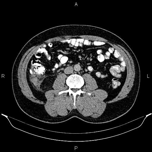 Acute appendicitis (Radiopaedia 84780-100240 Axial C+ portal venous phase 56).jpg