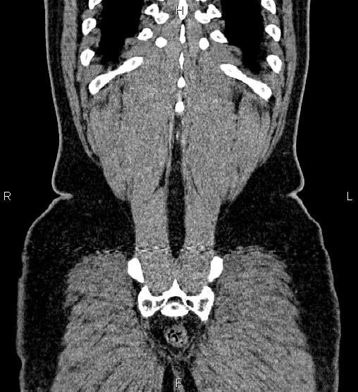 Acute appendicitis (Radiopaedia 84780-100240 Coronal C+ portal venous phase 78).jpg